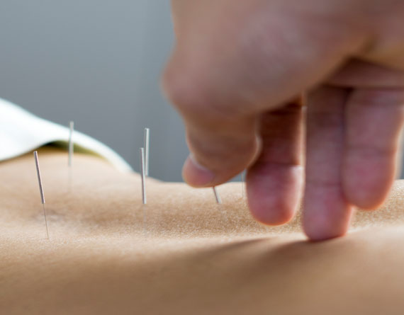10 reasons to try acupuncture