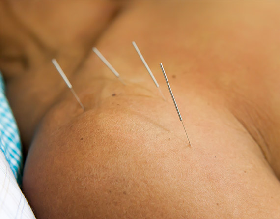 San Diego Acupuncture AcuClinic - Shoulder Pain.