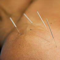 Acupuncture